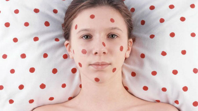 Medicii atenționează despre pericolul infectării cu rujeolă, o boală extrem de contagioasă