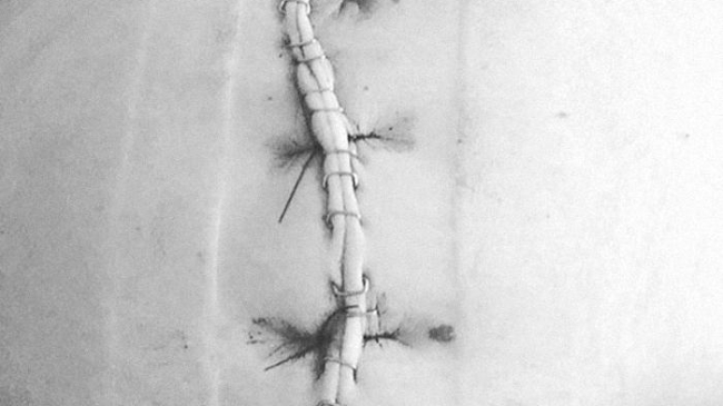 «Я родила своего ребенка»: честный пост о кесаревом сечении