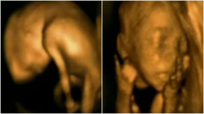 Imagini unice: cu ce se ocupă micuții în burticile mămicilor?