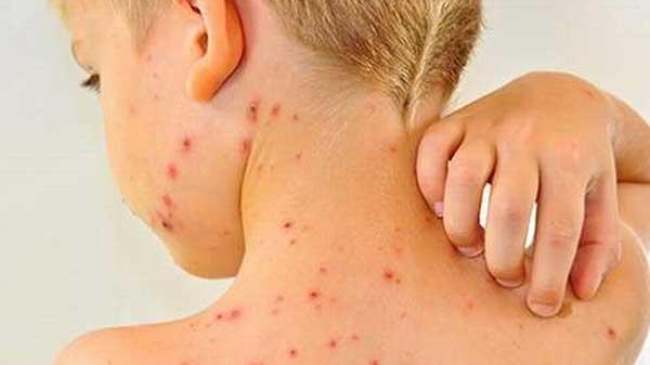 Европу охватили массовые вспышки кори