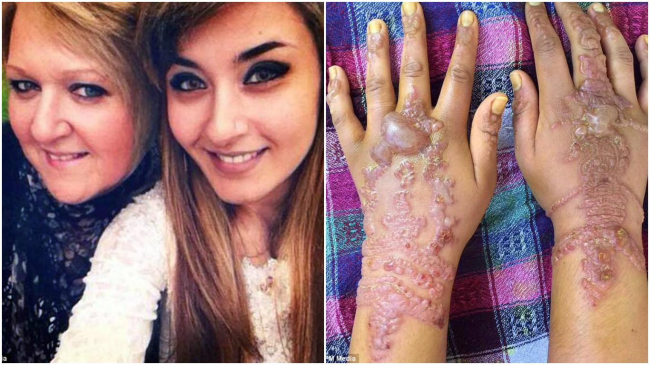Și-a făcut tatuaj cu hennă și a rămas cu cicatrici pentru toată viața!