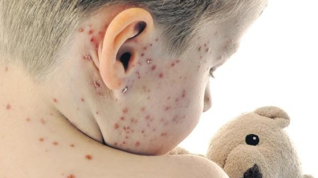 Focar de rujeolă la Odesa! Există decese