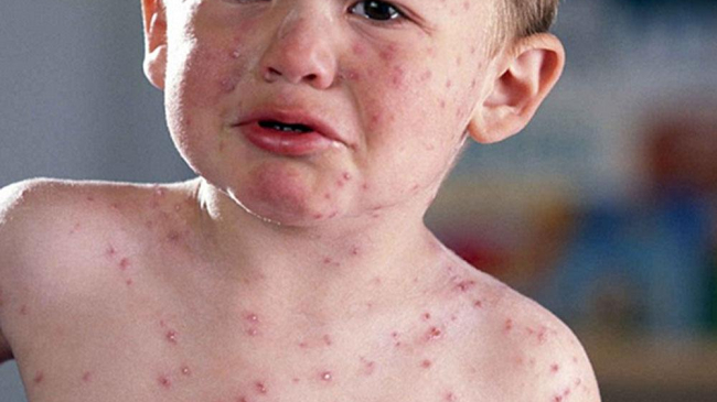 Epidemie de rujeolă în Europa! Infecţia continuă să facă victime în mai multe ţări