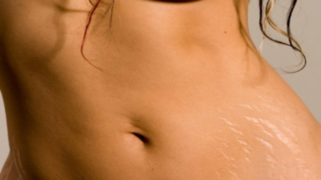 Top 10 remedii naturiste pentru a nu mai avea vergeturi!