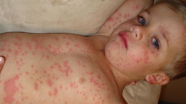 Коварная болезнь "подкосила" 800 жителей одесской области