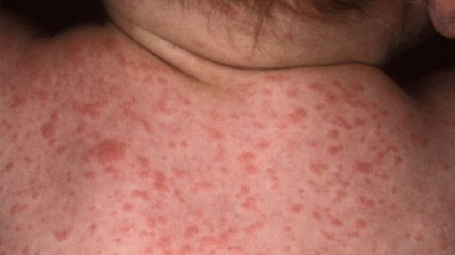 Sfatul medicului: Când putem face vaccin împotriva rujeolei