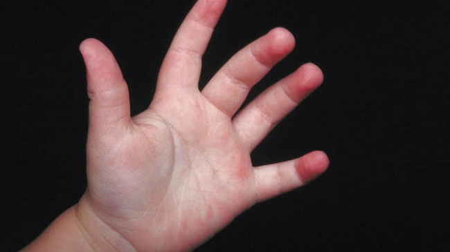 Беспрецедентный случай! Давала своему ребенку хлор в надежде излечить его от аутизма