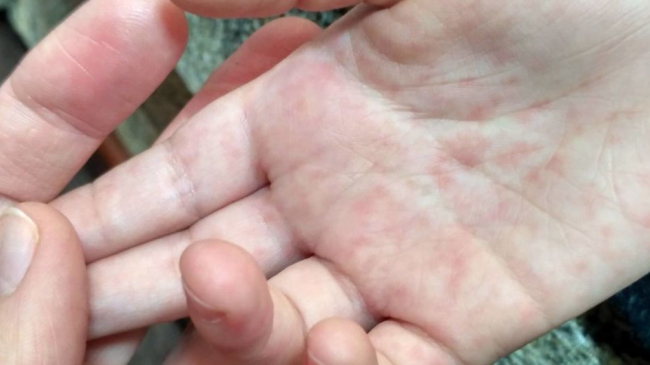 В 15 европейских странах зарегистрированы случаи заболевания корью: 35 человек скончались