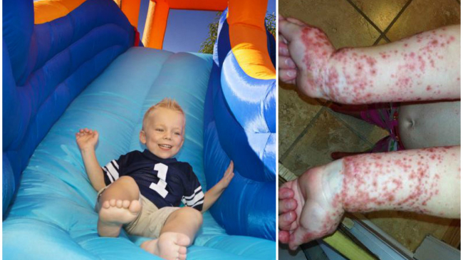 Врачи предупреждают: Надувной домик является источником стафилококков