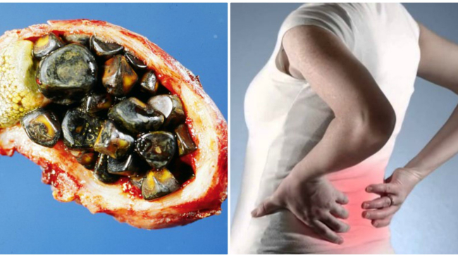 Din ce cauză facem pietre la rinichi