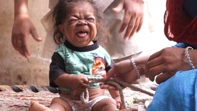 Are 23 de ani, dar arată ca un bebeluș