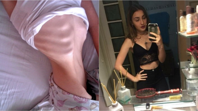 Povestea unei anorexice a devenit virală