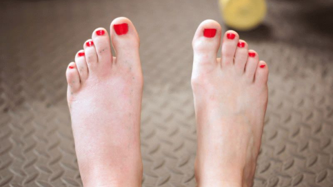 Как избавиться от отеков ног в домашних условиях?