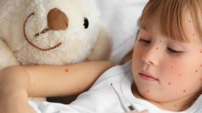 Уровень опасности в связи с распространением кори в Молдове снизили с оранжевого до желтого