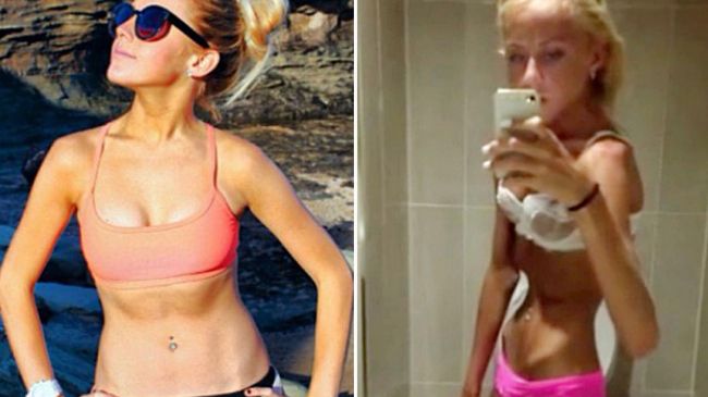 Австралийка довела себя до анорексии, чтобы быть похожей на Миранду Керр
