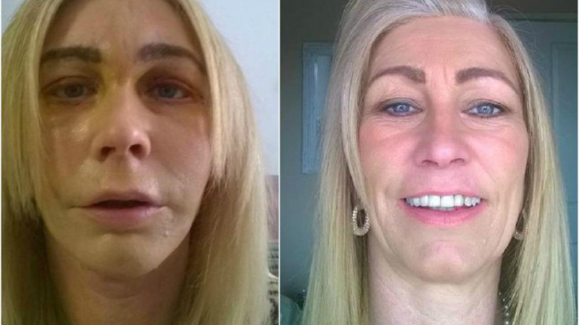 Мать четверых детей потратила детские пособия на пластические операции