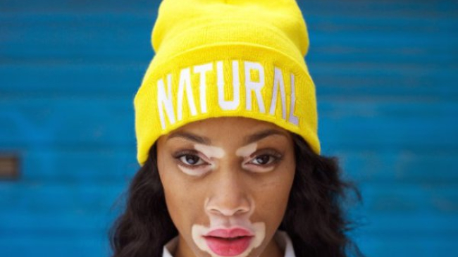 Шантель Браун-Янг - модель с редким заболеванием кожи