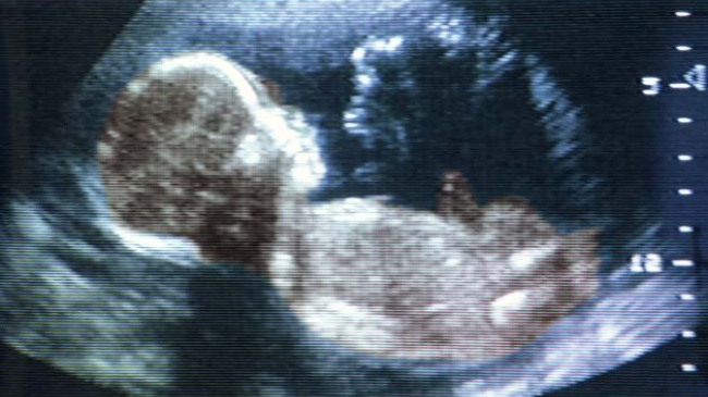 În Moldova este discutat dreptul copilului nenăscut la viaţă