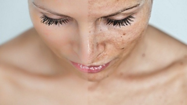 Кислотный пилинг – когда, кому, для чего?