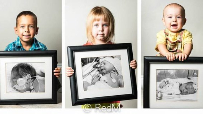 Выросшие дети, которые родились раньше срока, показали свои первые фото