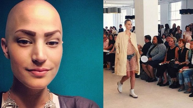 Больная раком американка решила начать карьеру модели