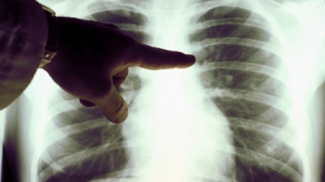 В РМ из-за халатности врача 59 детей заразились туберкулезом